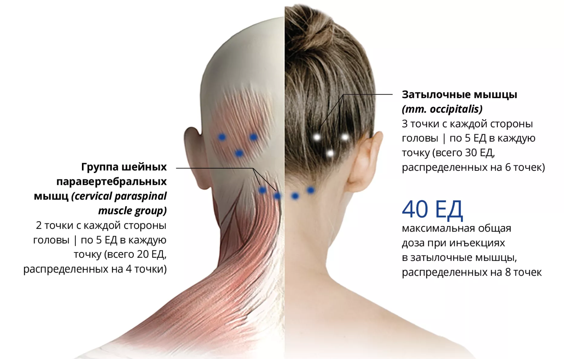 Хроническая мигрень
